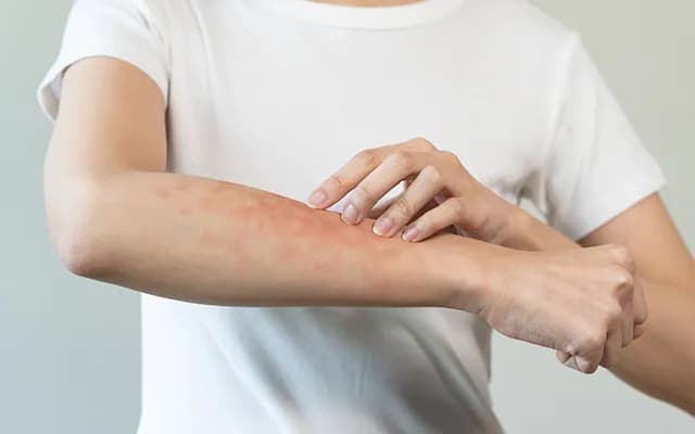 Güneş Alerjisi Belirtileri Nelerdir?
