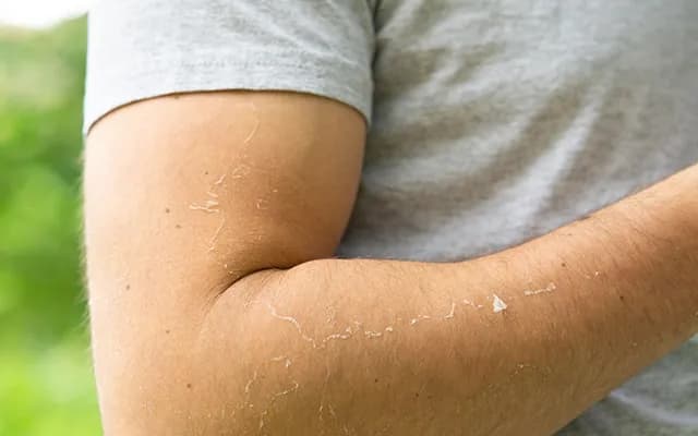 Güneş Lekesi Nedir? Nasıl Geçer?