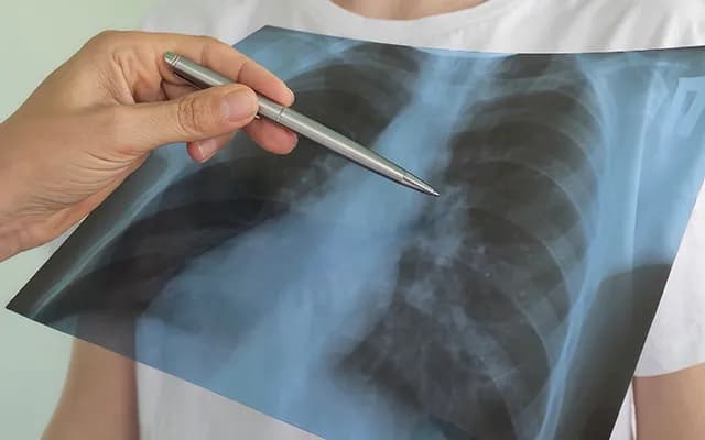Akciğer Kanseri Belirtileri Nelerdir? Neden Olur?